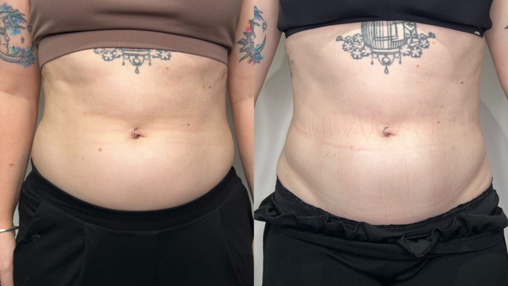 Lipo Lift Erfahrungen